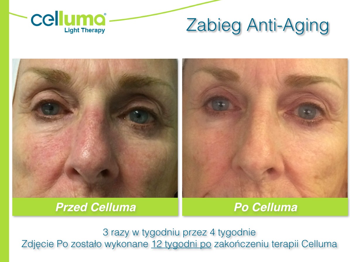 Celluma - before after